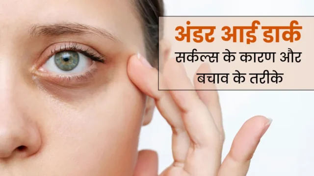 Dark-Circles-Causes-Treatment-ma.webp.webp