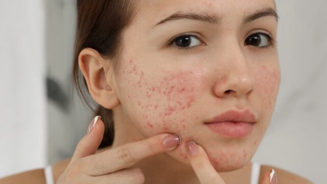 Hormonal-and-Cystic-Acne_742671934.jpg